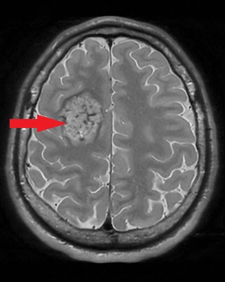 Guz nienowotworowy - naczyniak jamisty - widok osiowy