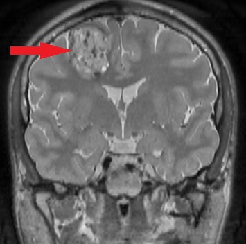 Guz nienowotworowy - naczyniak jamisty prawego płata czołowego.