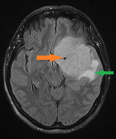 Meningioma w sekwencji flair.