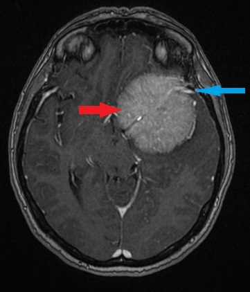 Meningioma w sekwencji T1 z kontrastem.