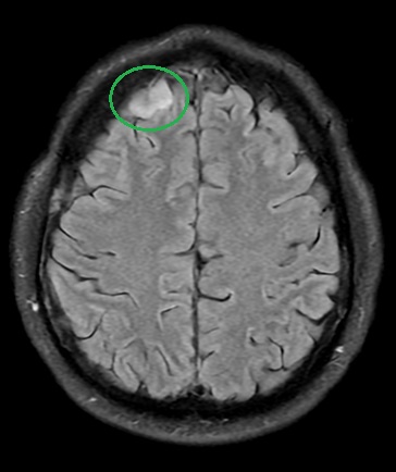 Meningioma w FLAIR.