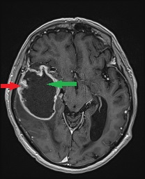 Guz nowotworowy - glioblastoma (glejak wielopostaciowy) - najczęstszy złośliwy nowotwór pierwotny.