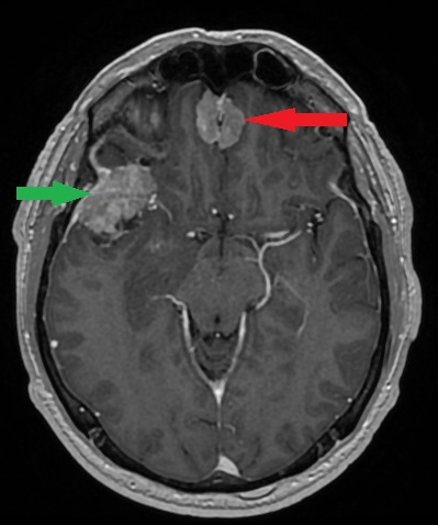 Guzy wewnątrzczaszkowe niezłośliwe - mnogie oponiaki.