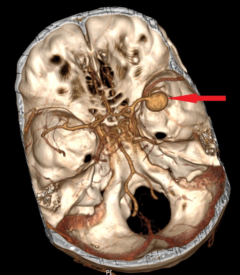 Guz nienowotworowy - tętniak RICA - rekonstrukcja 3D