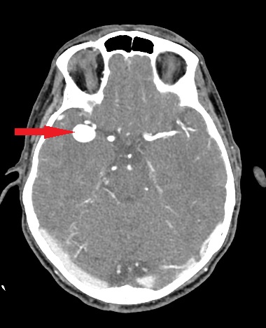 Guz nienowotworowy - duży tętniak tętnicy środkowej mózgu prawej.