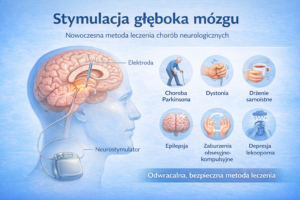 Ilustracja medyczna przedstawiająca stymulację głęboką (stymulacja głęboka mózgu) mózgu DBS z elektrodą w mózgu i neurostymulatorem.