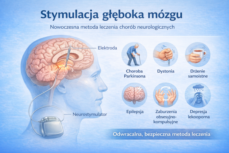 Ilustracja medyczna przedstawiająca stymulację głęboką (stymulacja głęboka mózgu) mózgu DBS z elektrodą w mózgu i neurostymulatorem.