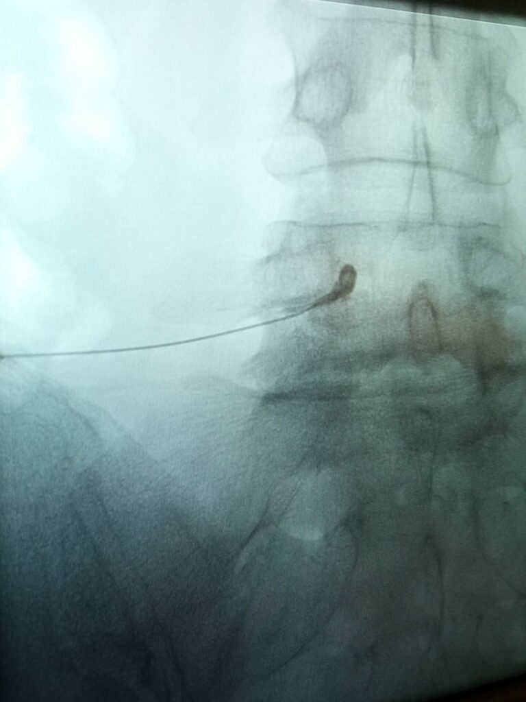 Ryc. 1.Radiogram wykonany w trakcie przedotworowej iniekcji nadtwardówkowej. Na zdjęciu widać kontrast radiologiczny podany przez igłę - używa się go do potwierdzenia prawidłowej dystrybucji leku oraz wykluczenia niezamierzonej donaczyniowej lub podoponowej iniekcji.
