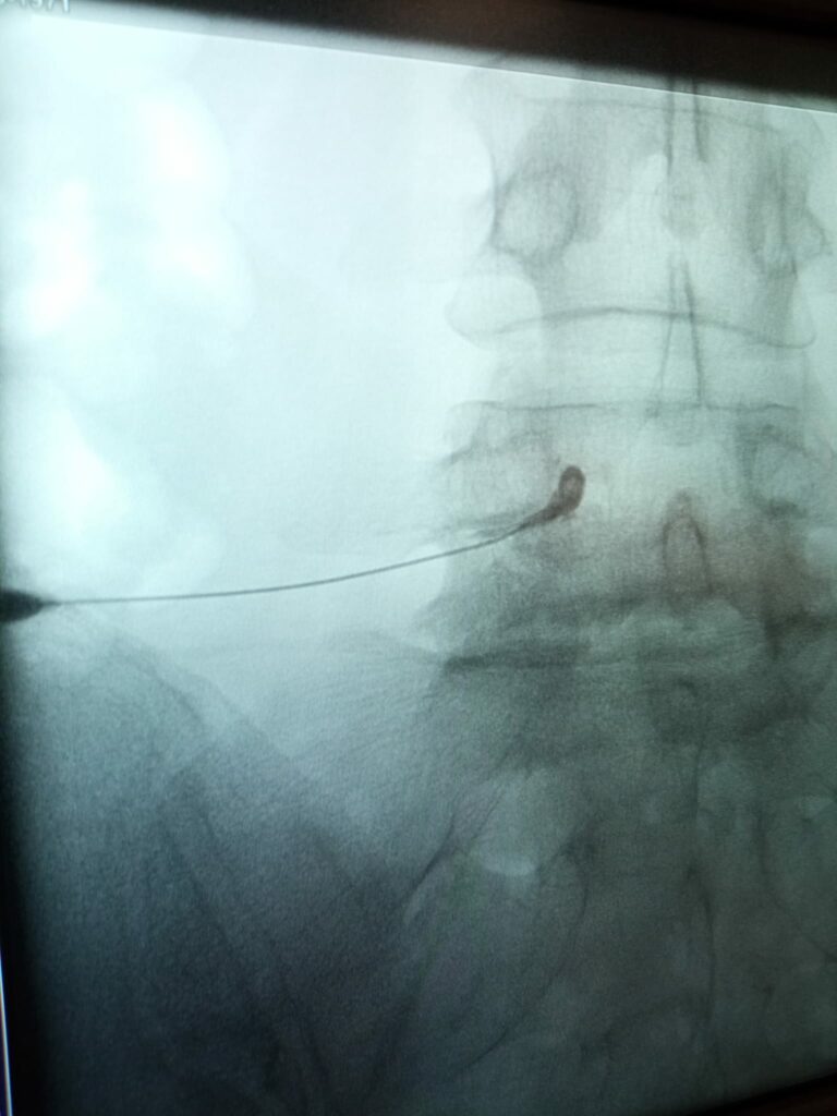 ESI transforaminal 2