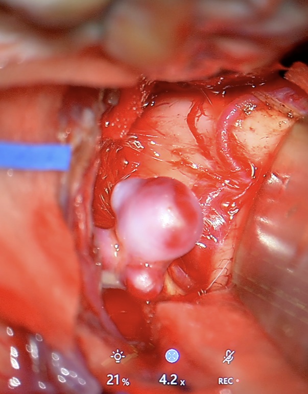 Zdjęcie z mikroskopu operacyjnego przedstawiające tętniaka tętnicy środkowej mózgu