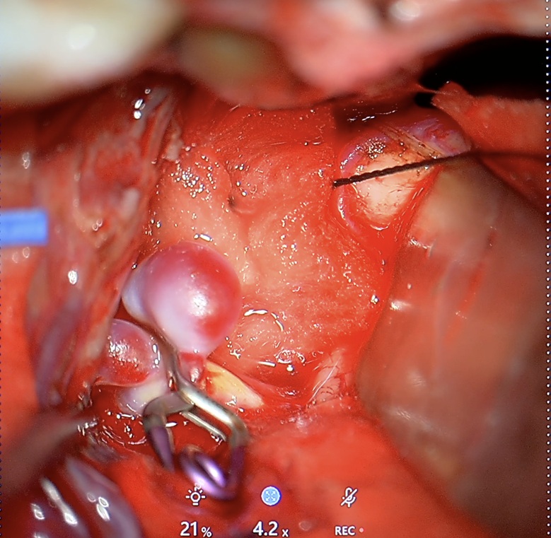 Zdjęcie z mikroskopu operacyjnego przedstawiające tętniaka tętnicy środkowej mózgu